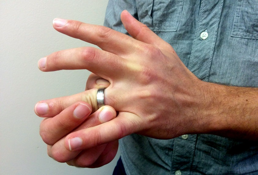 6 Easy Hacks Guide: How to Get Stuck Ring Off a Swollen Finger?